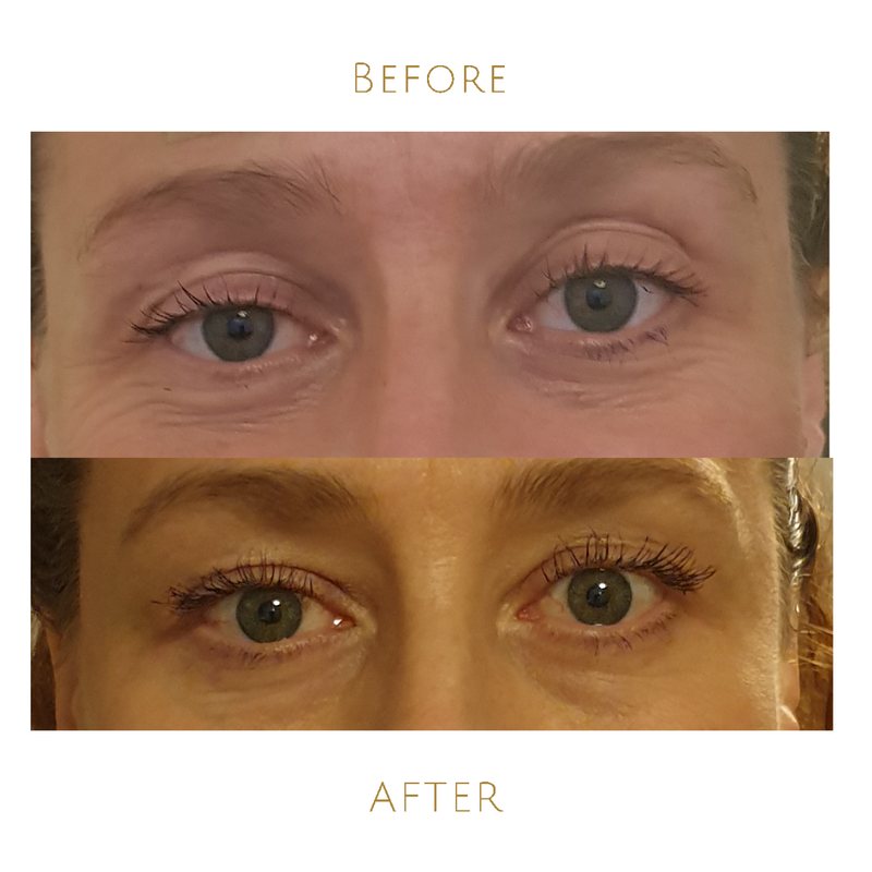 Hanna Sahlman's eye area at 46 and at 50, after four years of consistent Qigong and Face Yoga practice.
